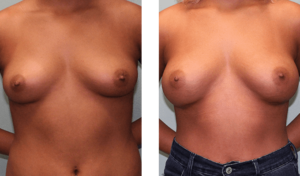 Augmentation 6 months after surgery. Early-20s. 205ml saline implants, above the muscle.