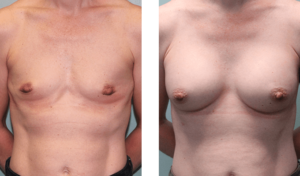 Augmentation 6 months after surgery. Early-40s. 350ml silicone implants, under the muscle.