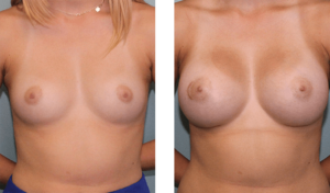 Augmentation 6 months after surgery. Late-20s. 450ml silicone implants, under the muscle. Also had a small benign tumor removed from the right breast.