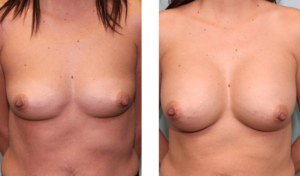 Augmentation 6 months after surgery. Late-20s. 350ml silicone implants, under the muscle.