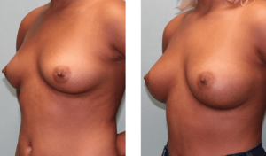 Augmentation 6 months after surgery. Mid-30s. 300ml silicone implants, under the muscle.