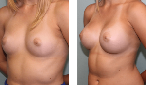 Augmentation 6 months after surgery. Late-20s. 450ml silicone implants, under the muscle. Also had a small benign tumor removed from the right breast.