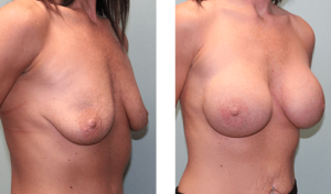 Augmentation 3 months after surgery. Early-30s. 415ml silicone implants, above the muscle.