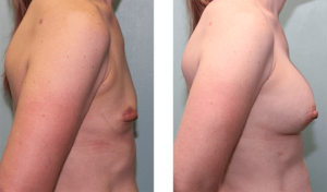 Augmentation 6 months after surgery. Early-40s. 350ml silicone implants, under the muscle.