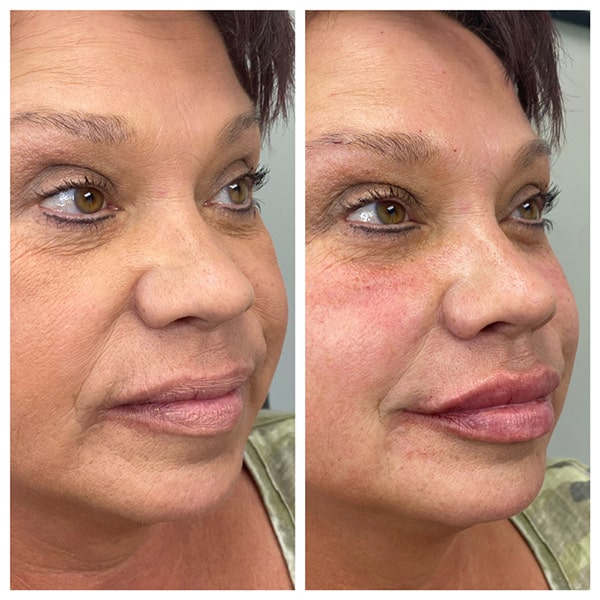 before-and-after-filler-in-greer-plastic-surgery-01