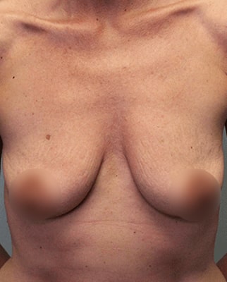 Before breast lift surgery - 002