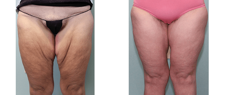 before-after-thigh-lift-001
