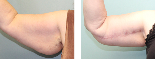 Before and after arm lift left arm front view