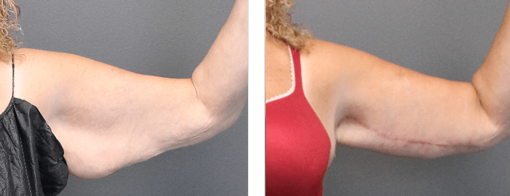Before and after arm lift right arm front view
