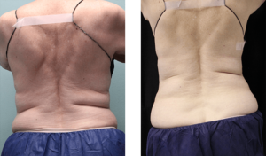 6 months after treatment. Late-70s. Two CoolSculpting sessions on waist and abdomen.