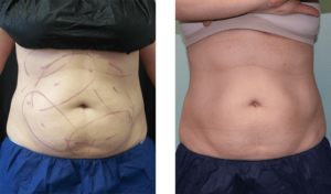4 months after treatment. Mid-40s. Two CoolSculpting sessions on abdomen.
