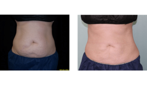 6 weeks after treatment. Late-30s. Two CoolSculpting sessions on abdomen.