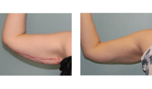 6 months after treatment. Late-30s. Two CoolSculpting sessions on upper arms.