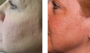 2 months after treatment. Late-40s. Series of 3 laser peels with profractional.