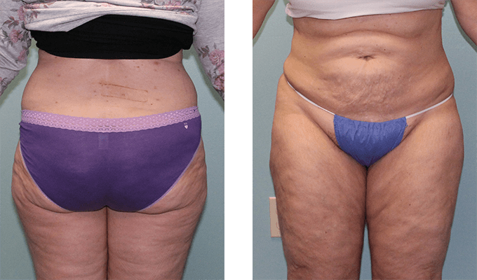 6 months after surgery. Early-40s. Liposuction abdomen, waist, outer thighs.