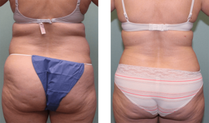 2 months after surgery late-40s. Liposuction of abdomen and waist.