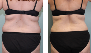 6 months after surgery late-40s. Liposuction of abdomen, waist, and back bra roll.