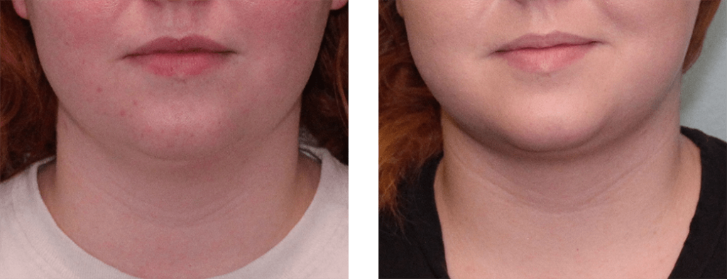 3 months after surgery. Early-20s. Liposuction of chin.