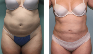 2 months after surgery late-40s. Liposuction of abdomen and waist.