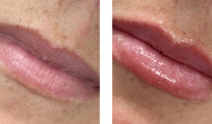 before-after-non-invasive-lips