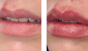 before-after-non-invasive-lips