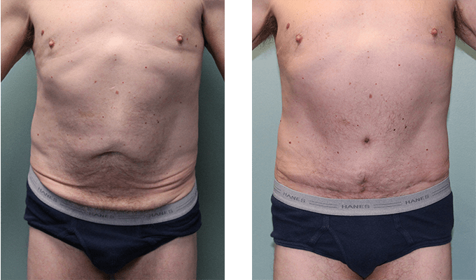 before and after tummy tuck and skin removal Front - 5