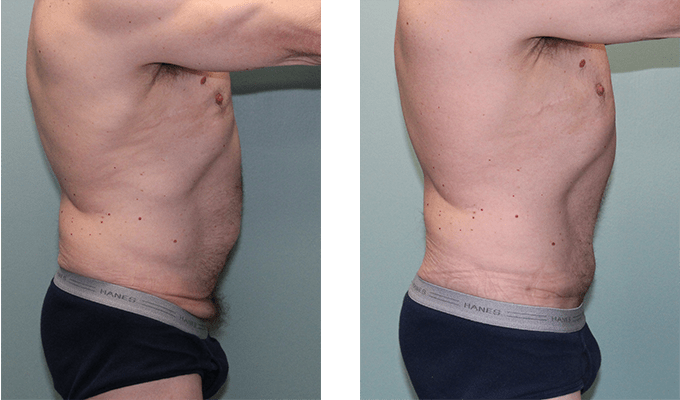 before and after tummy tuck and skin removal Side - 5