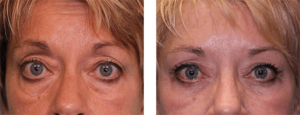 3 months after surgery. Early-60s. Upper and lower eye lift.
