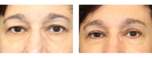 3 months postop early 50s upper and lower eye lift and lateral brow lift