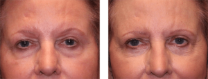 3 months after surgery. Mid-60s. Upper and lower eye lift.