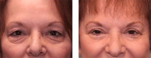 6 months after surgery. Late-60s. Upper and lower eye lift.