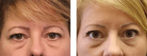 6 months after surgery. Late-40s. Upper and lower eye lift, open brow lift.