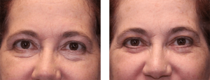 3 months after surgery. Late-50s. Lower eye lift.