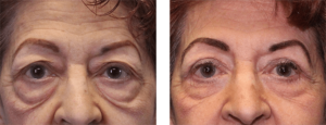 7 months after surgery. Mid-70s. Upper and lower eye lift.