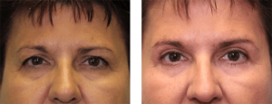4 months after surgery. Late-50s. Upper and lower eye lift.