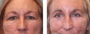 Patient in her late 50s who is 6 months out after upper and lower blepharoplasty and brow lift.