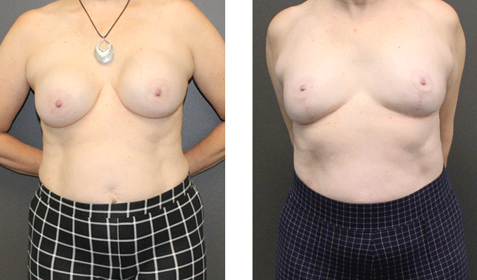 before and after breast implant gallery - 009