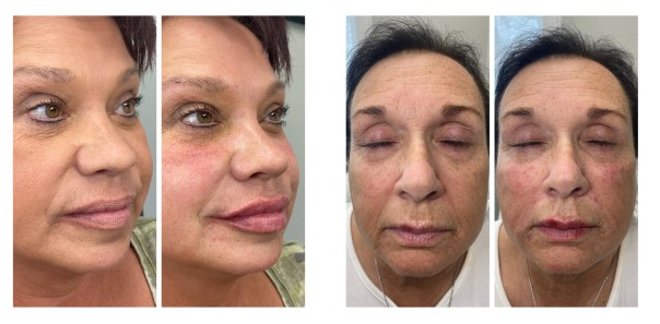 Before and after Sculptra filler