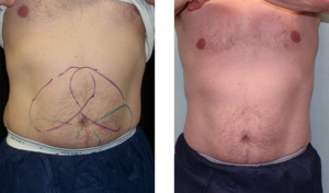 6 weeks after treatment. Early-60s. Two CoolSculpting sessions on waist and abdomen.