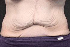 Before and after tummy tuck 1