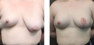 Patient is in her early 20's. Had an implant on one side and a reduction on the other to correct her asymmetry.