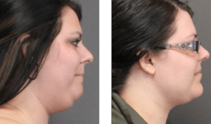 before and after chin liposuction side view - 020
