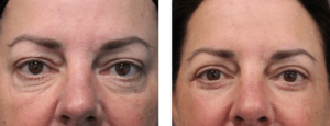 before and after upper and lower blepharoplasty - 013