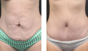 This patient is in her mid 40s. Abdominoplasty.