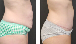 This patient is in her mid 40s. Abdominoplasty. Side view.