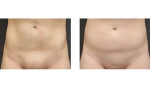 Patient is in her early 20's 3 month post op of liposuction of the mons pubis.
