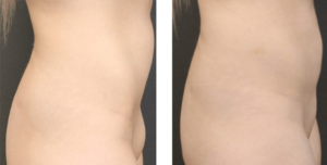 Patient is in her early 20's 3 month post op of liposuction of the mons pubis. Side view.