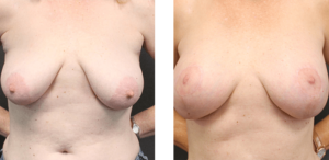 Patient is in her late 50's and had 345 silicone implants put in.