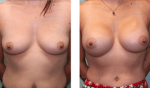 Before and After Breast Augmentation - Front View 003