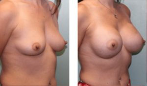 Before and After Breast Augmentation - Side View 003